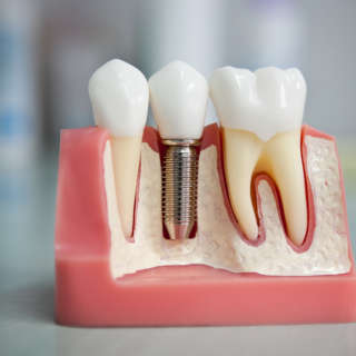 implant implant